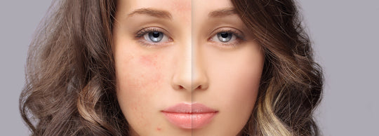 Suffer from hyperpigmentation? You need to read this.